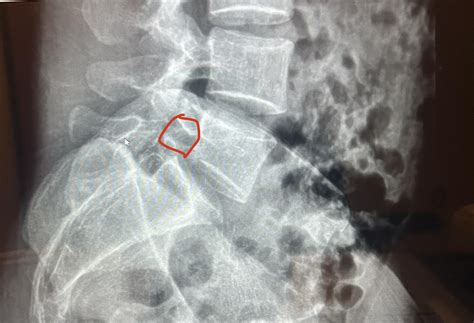 L5 pars fracture, grade 1 spondylolisthesis L5-S1. : r/Spondylolisthesis
