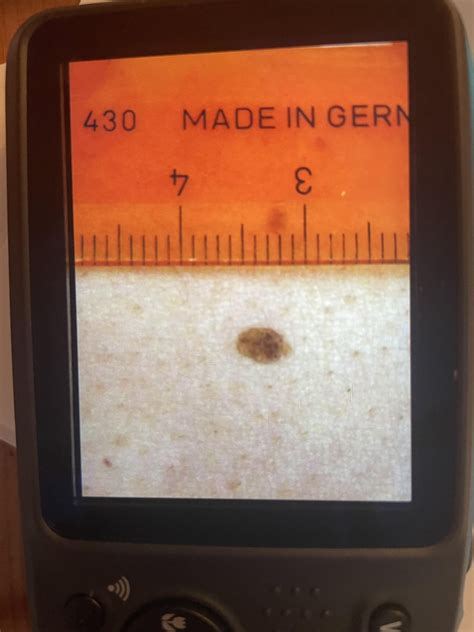 Seborrheic keratosis or possible melanoma? : r/Melanoma