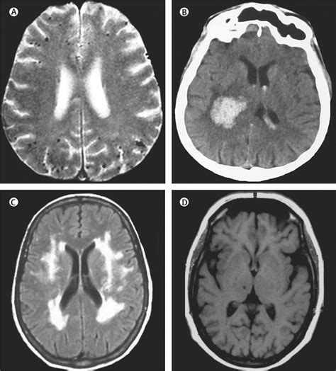 Cerebral small vessel disease: from pathogenesis and clinical ...