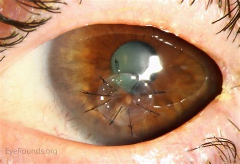 Cornea transplant types, success rate, vision after transplant, rejection, complications