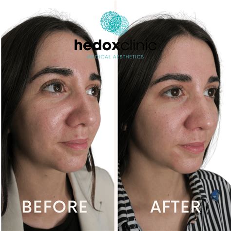 Nasolabial Folds Treatment London | Nasal Fold Filler - Hedox Clinic