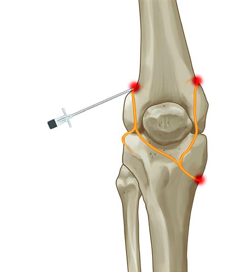 Genicular Nerve Block & Radio Frequency Ablation for Knee Pain ...