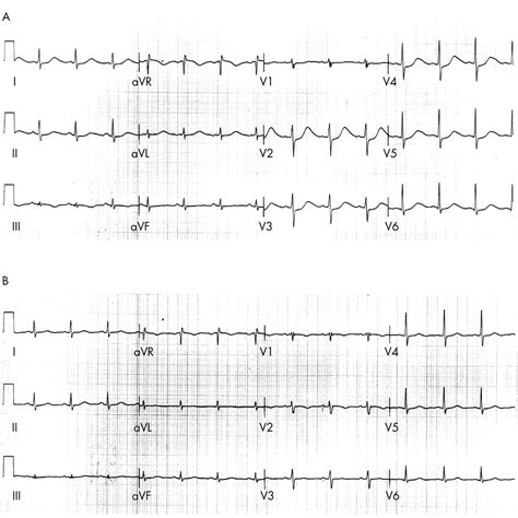 What Is Drug Induced Qt Prolongation at David Clinton blog