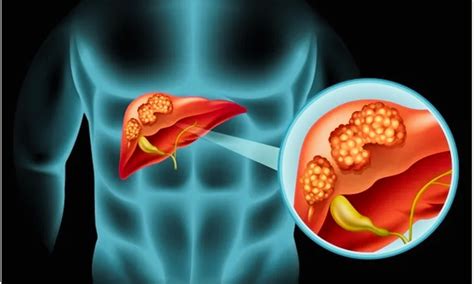 Neoadjuvant GOLP Boosts Event-Free Survival in High-Risk Intrahepatic ...