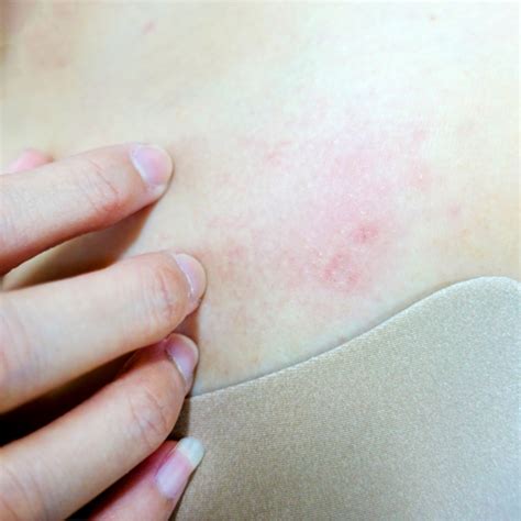 How to prevent itching and skin rashes during monsoon | SkinEasi – Skineasi