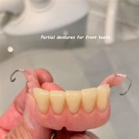 Image result for Front Teeth Partials Options