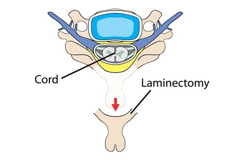 Lumbar Laminectomy With Fusion