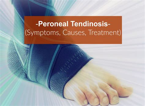 Peroneal Tendinosis (Symptoms, Causes, Treatment)