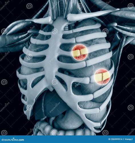 Anatomy and Human Body. Costochondral Separation, Separated Rib. Broken, Fractured Ribs Stock ...