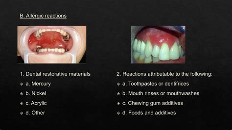 Image result for Classification Periodontitis