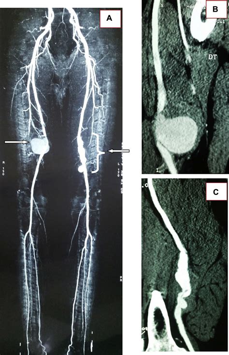 Endovascular Treatment of 2 True Degenerative Aneurysms of Superficial Femoral Arteries - Annals ...