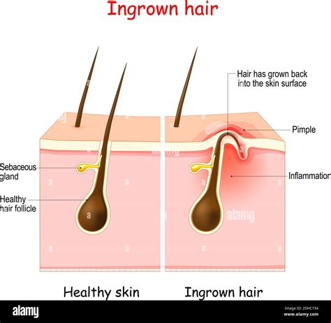 Ingrown Hair Removal
