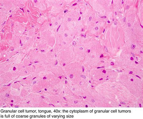 Pathology Outlines - Granular cell tumor