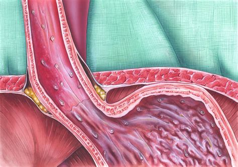 Bile Reflux: Clinical Considerations - Gastroenterology Advisor