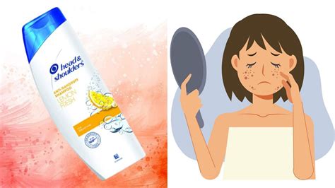 Head And Shoulders Shampoo Reaction