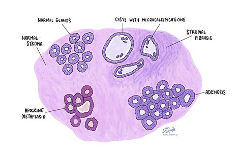 Your pathology report for fibrocystic change of the breast | MyPathologyReport