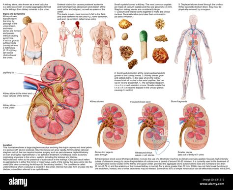 Medical chart showing the signs and symptoms of kidney stones Stock Photo - Alamy