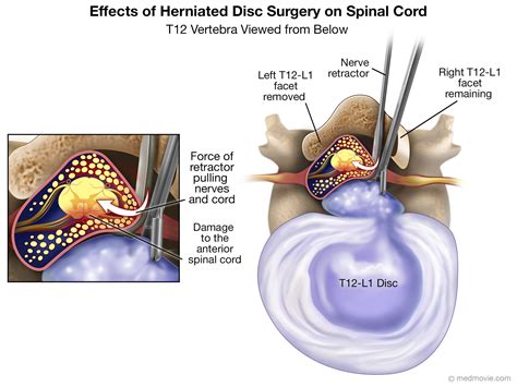 Herniated Disc In Back Surgery Recovery Time at Fernande Frank blog