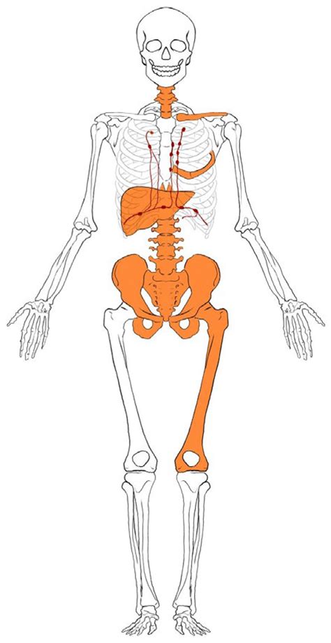 Vertebral Metastasis in a Bronchial Carcinoid: A Rare Case Report with ...