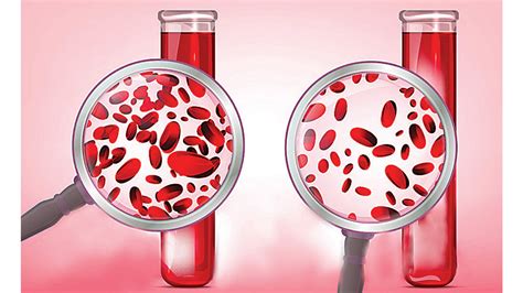 Anemia : मुलींमध्ये रक्‍तक्षयाचे प्रमाण वाढले; ‘एनएफएचएस’ने दिली माहिती ...