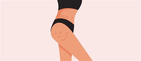 Do Stretch Marks Go Away When You Lose Weight?