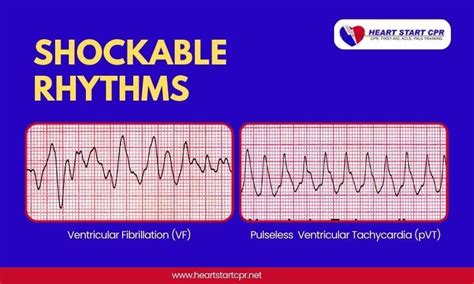 What Are Shockable Rhythms? V-Fib, V-Tach, & When to Defibrillate