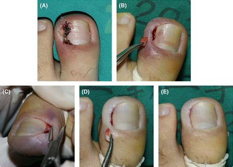 Partial Nail Avulsion