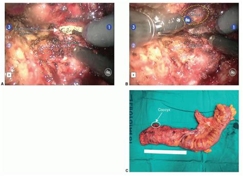 Image result for Apr Resection Surgery