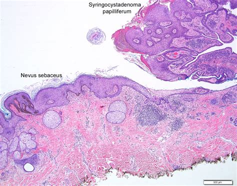 Pathology Outlines - Nevus sebaceus of Jadassohn