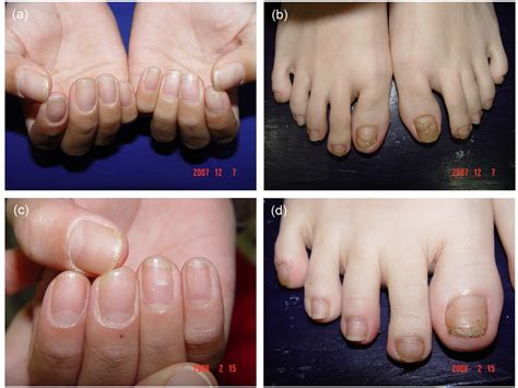Psoriasis Toenails Treatment