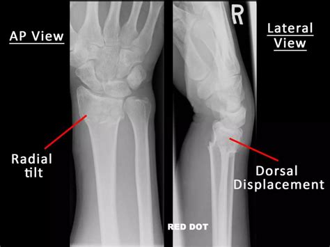 Distal End Radius Fractures - Colles, Smiths & Bartons | PPTX