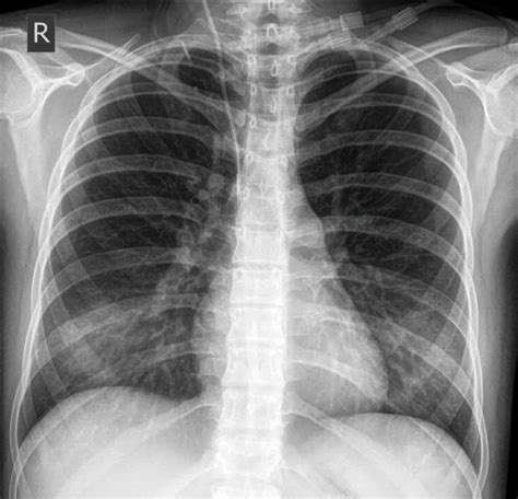 Upright Chest X Ray Showing The Central Venous Catheter Arrow L | The ...