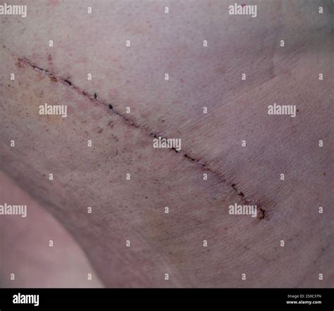 Hip surgery scar after 3 weeks Stock Photo - Alamy