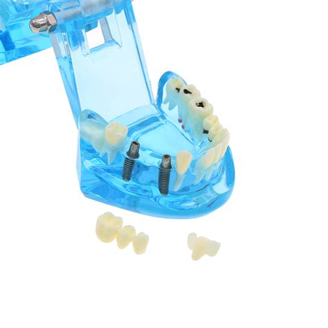 Dental Implant Teeth Model Bridge Restoration | Ubuy India