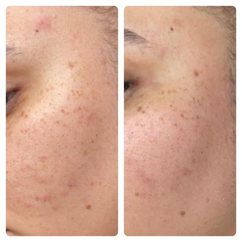 I’ve been using adapalene and 4% niacinamide for 2 weeks and after no irritation added benzoyl ...