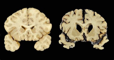 CTE Brain 的图像结果