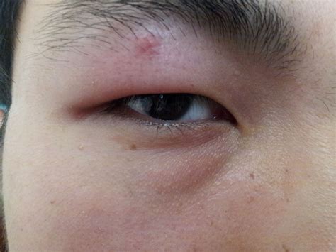 在新加坡孩子眼皮上长了麦粒肿怎么办？