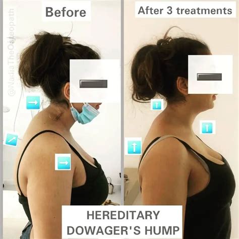 Hereditary Dowager’s Hump – Nadia The Osteopath