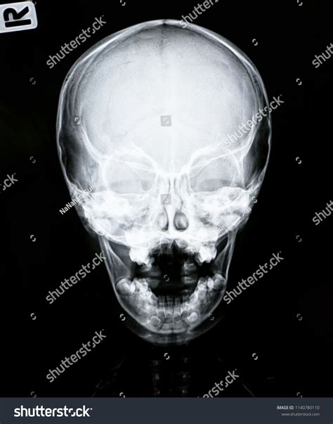 Xray Image Of Baby Skull Ap View Stock Photo 304378286