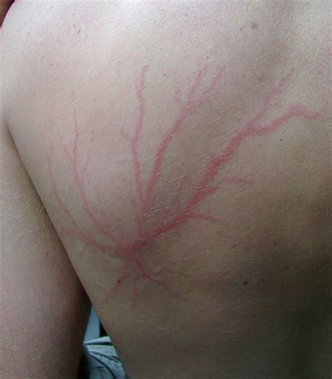 Lightning strike survivors show off their incredible markings | Daily ...