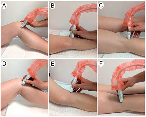 Validation of Ultrasound for Quantification of Knee Meniscal Tissue: A ...