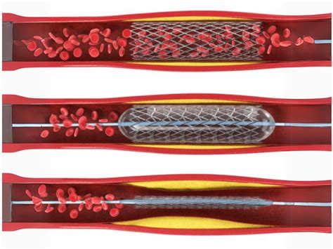 Dr Mahesh K Shah | Best Interventional Cardiologist in Mumbai