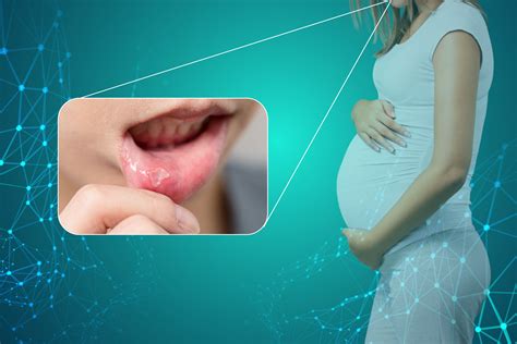 Sore Throat And Mouth Ulcers In Pregnancy - Infoupdate.org