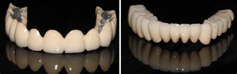 Prosthetic rehabilitation with implant-supported fixed prosthesis in a ...