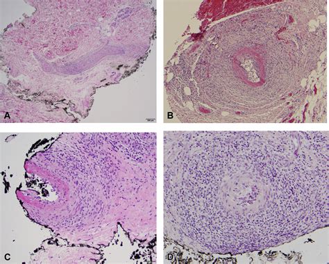 Macular lymphocytic arteritis: Clinical-pathologic correlation of a rare vasculitis - JAAD Case ...