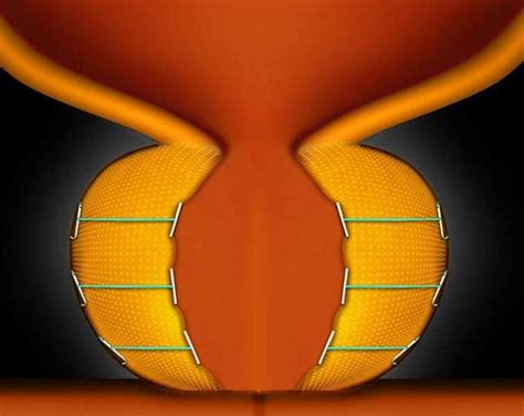 Image result for Urolift Recovery Process