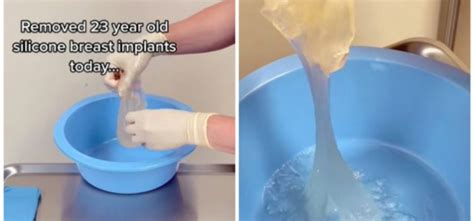 Doctor Reveals The Insides Of A 23-Year-Old Breast Implant