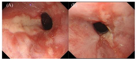 Primary Epstein–Barr Virus-Positive Mucocutaneous Ulcer of Esophagus: A ...