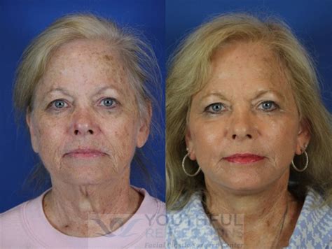 CO2 Laser Skin Resurfacing Before & After Photos Patient 43 | Nashville, TN | Youthful Reflections