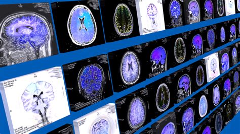 Moderate Chronic Small Vessel Ischemic Disease - Pregnancy Informations
